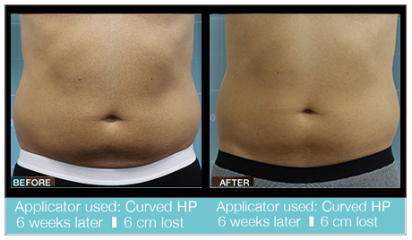 velashape before and after tummy