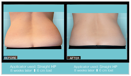 velashape before and after waist