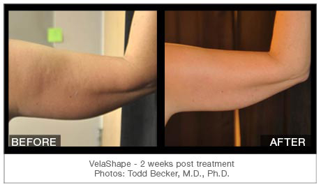 velashape before and after arm