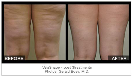 velashape before and after thigh