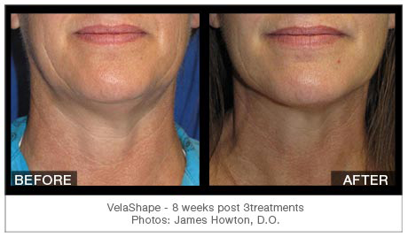 velashape before and after chin