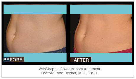 velashape before and after