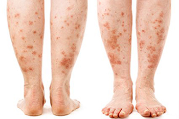 Skin Diseases Treatment Abu Dhabi