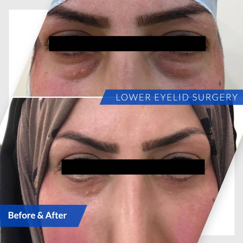 Lower eyelid surgery-before-after