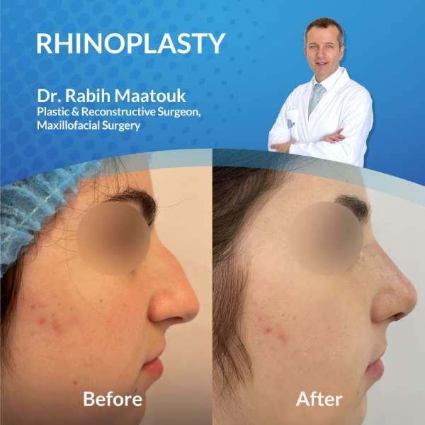 Rhinoplasty Abu Dhabi