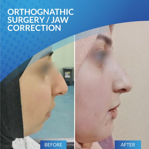 Orthognathic Surgery/Jaw Correction
