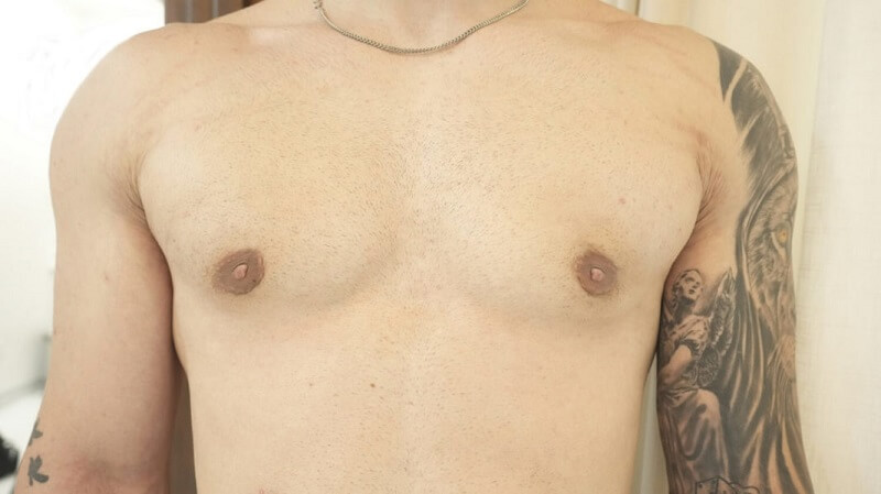 AFTER Gynecomastia