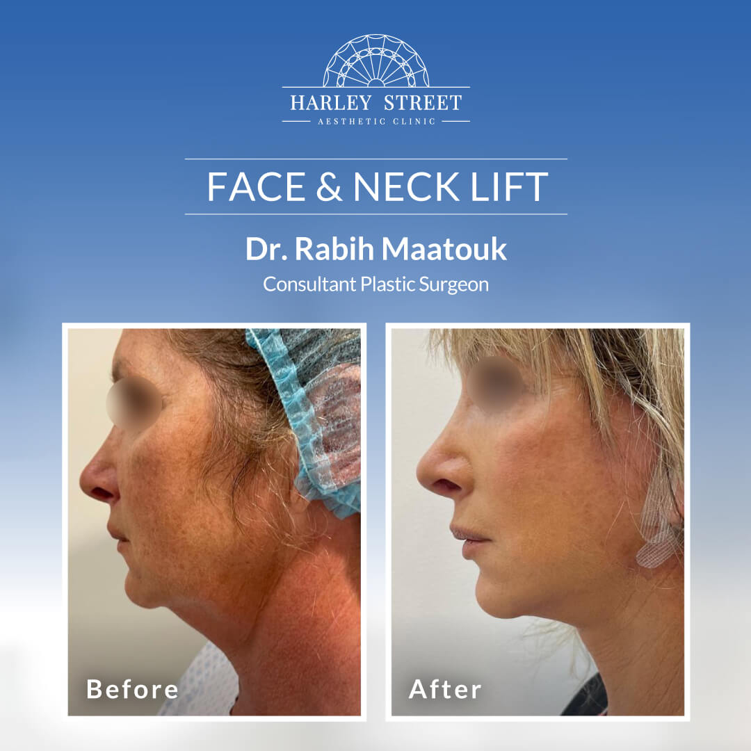 Face & Neck Lift Abu Dhabi