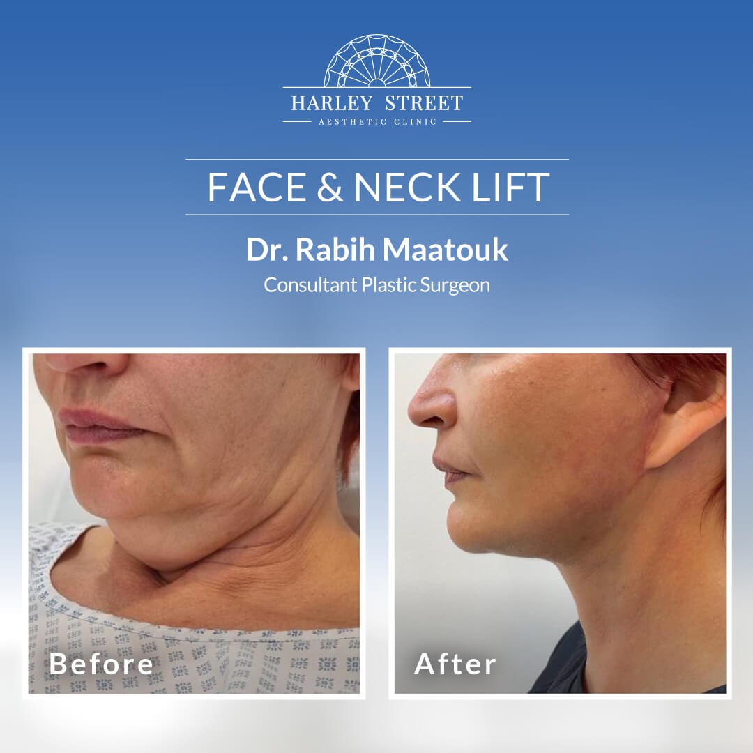 Face & Neck Lift Surgery Abu Dhabi