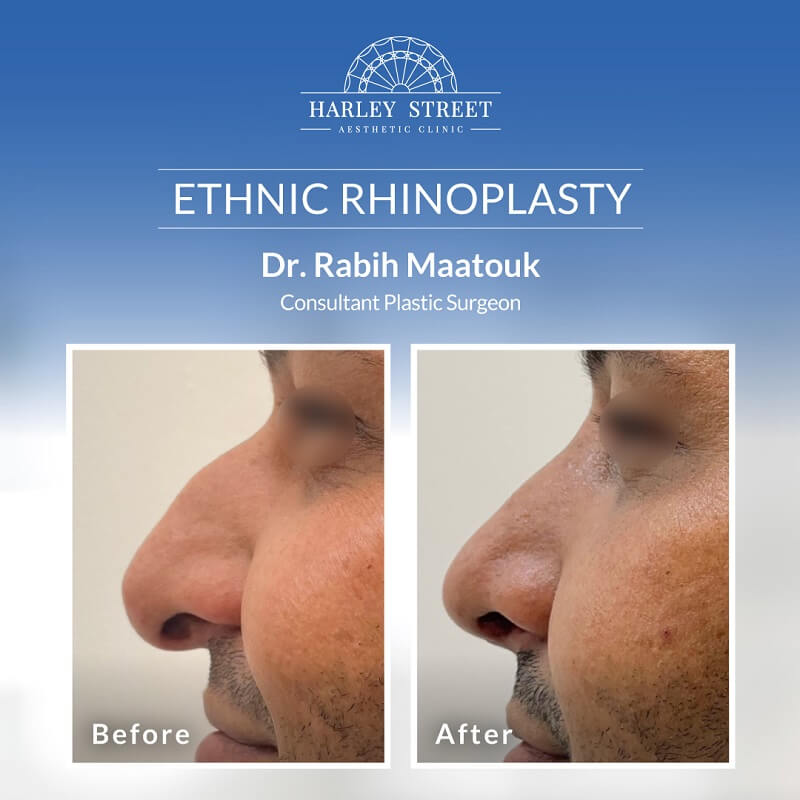 Dr.-Rabih Ethnic-Rhinoplasty