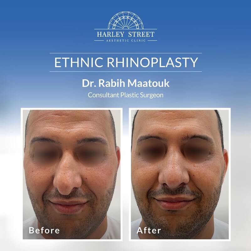 Dr.-Rabih Ethnic-Rhinoplasty