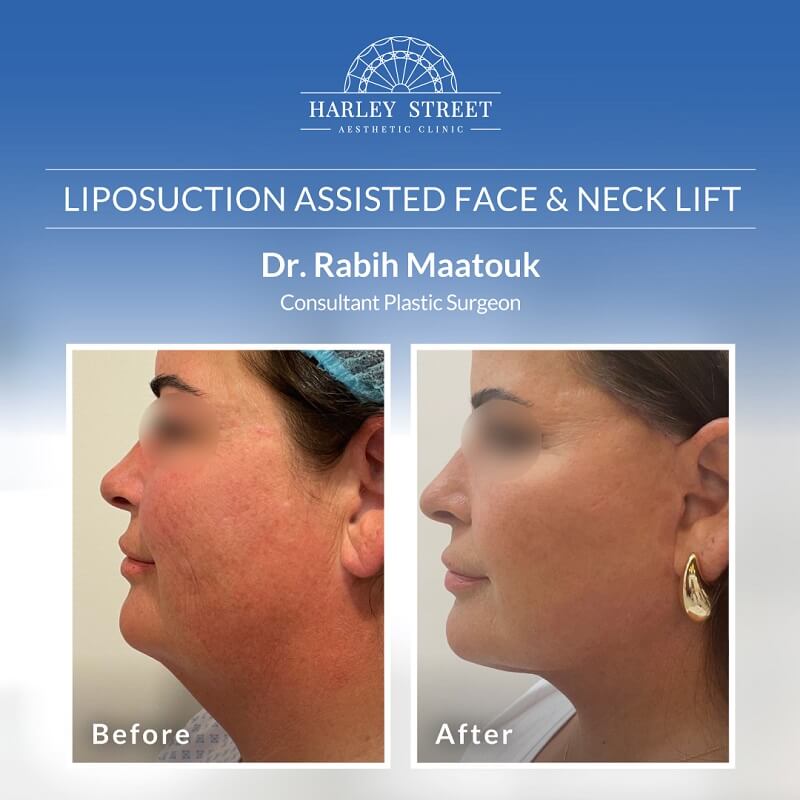 Dr.-Rabih Liposuction-Assisted-Face-&-Neck-Lift