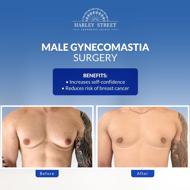 Gynecomastia Before & After