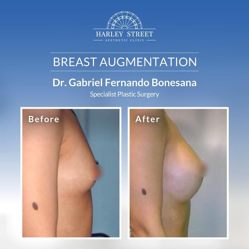 Breast Augmentation Before After Abu Dhabi