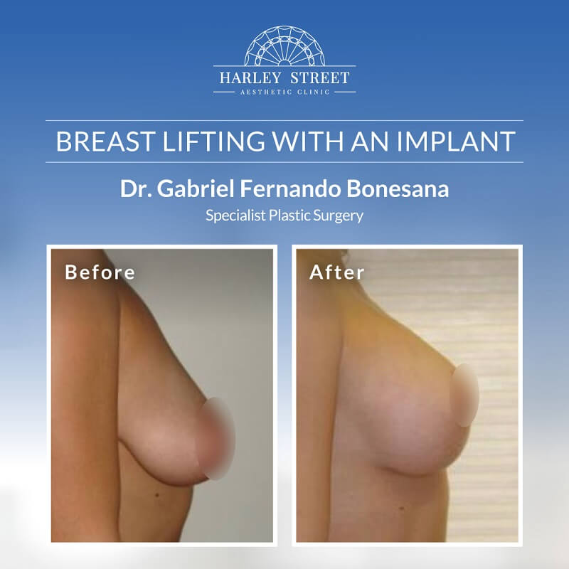 Breast-lifting-with-an-implant Before After