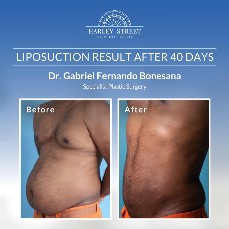LIPOSUCTION AFTER 40 DAYS