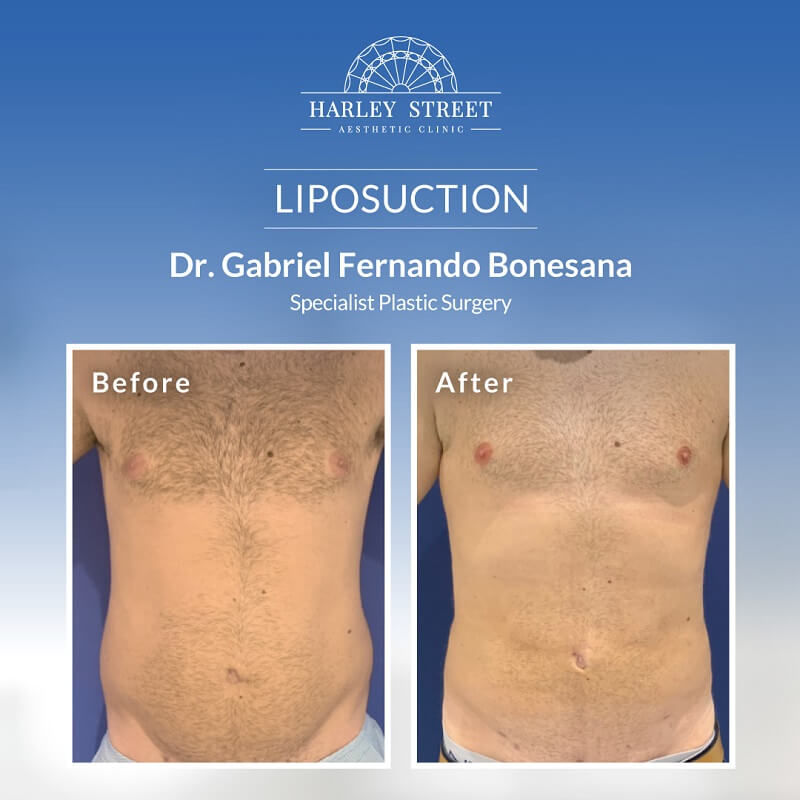Liposuction By Dr. Gabriel