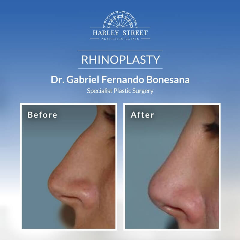 Rhinoplasty Before After