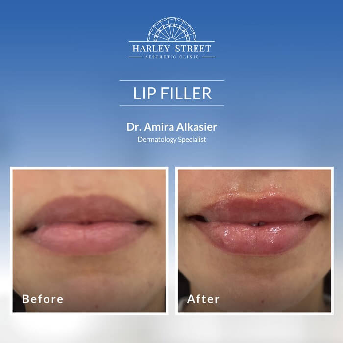 Dr. Amira-Before-After Lip Filler 1