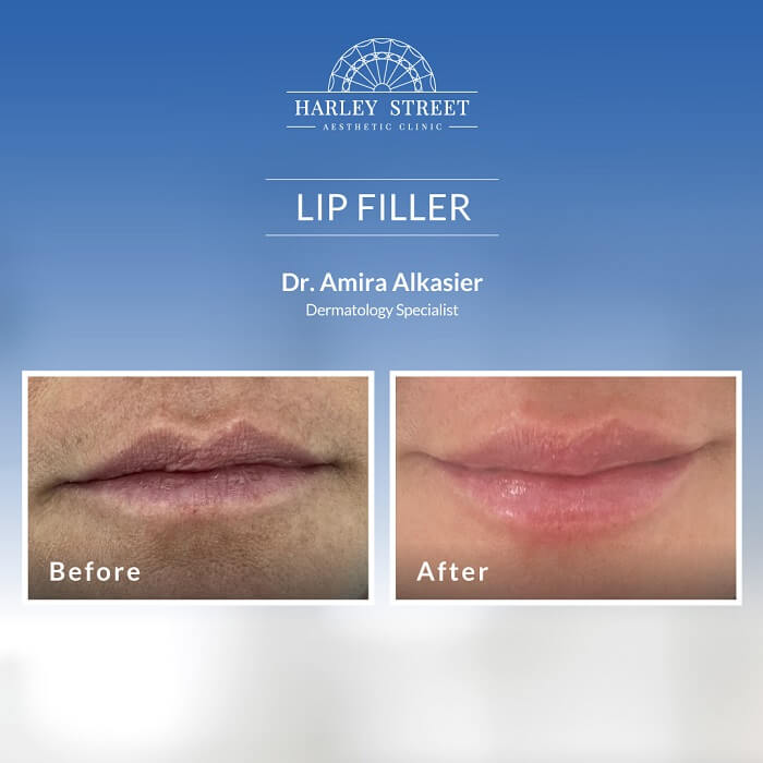 Dr. Amira-Before-After Lip Filler 2
