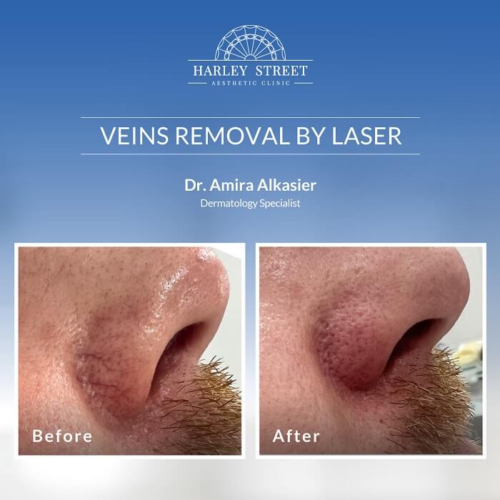 Dr. Amira Before-After Veins removal