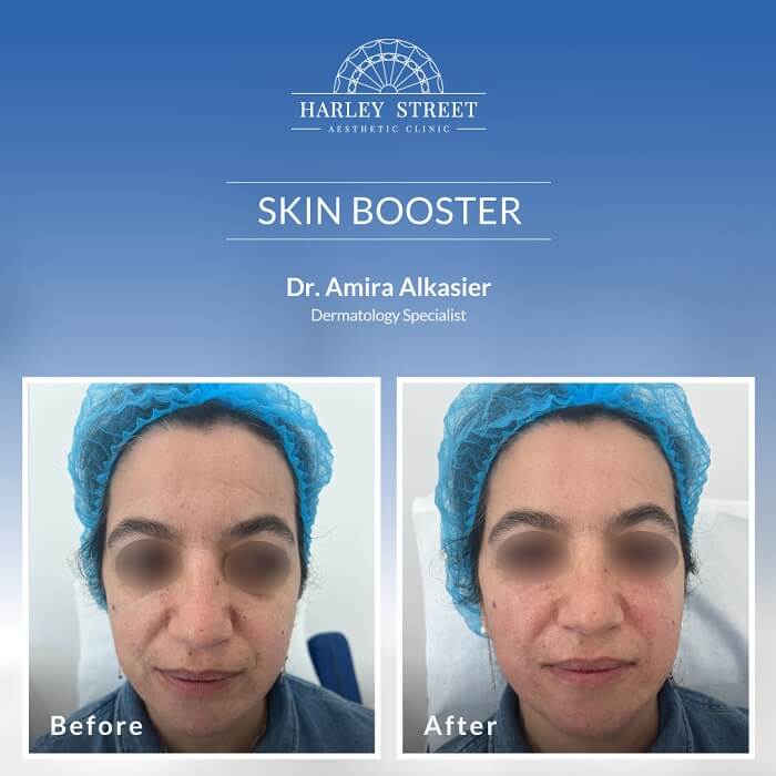 Dr. Amira Before-After skin booster