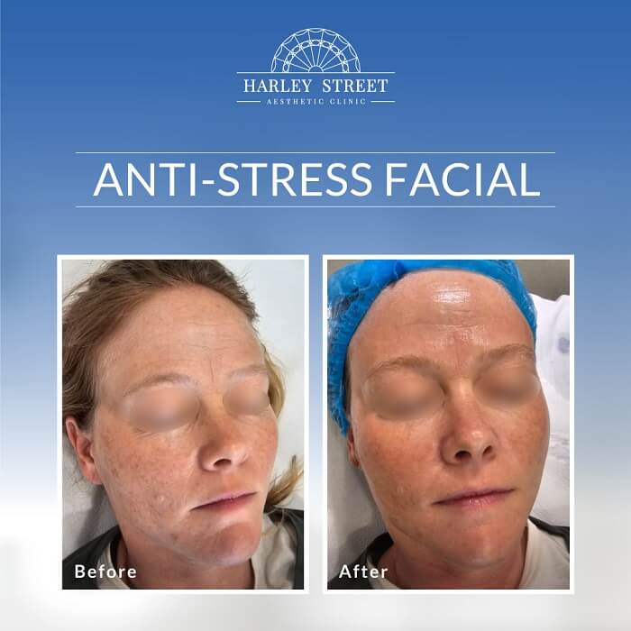 Before After-Anti-Stress Facial