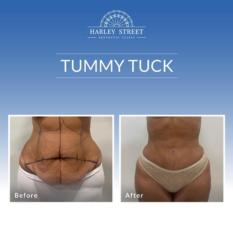 Tummy Tuck