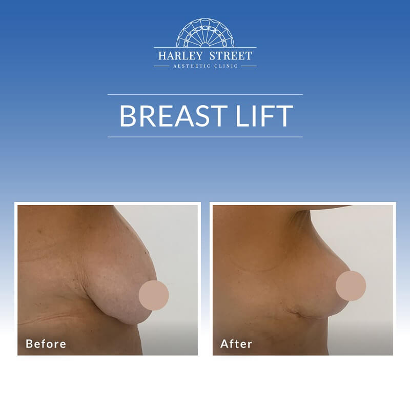 Breast Lift