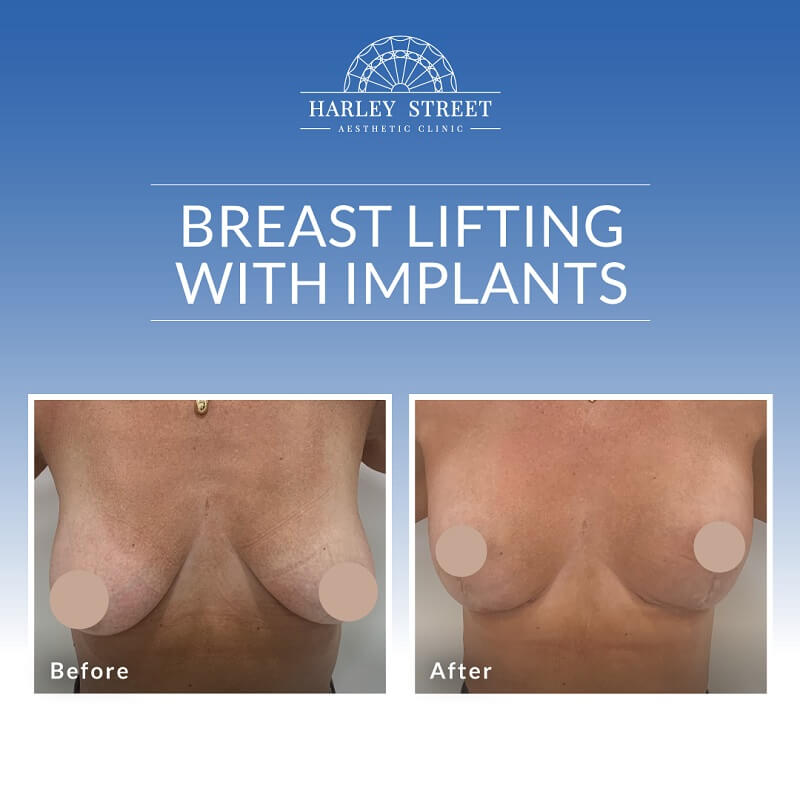 Breast Lifting With Implants