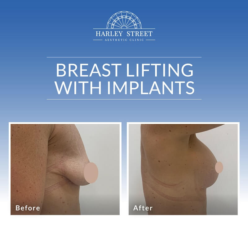 Breast Lifting With Implants