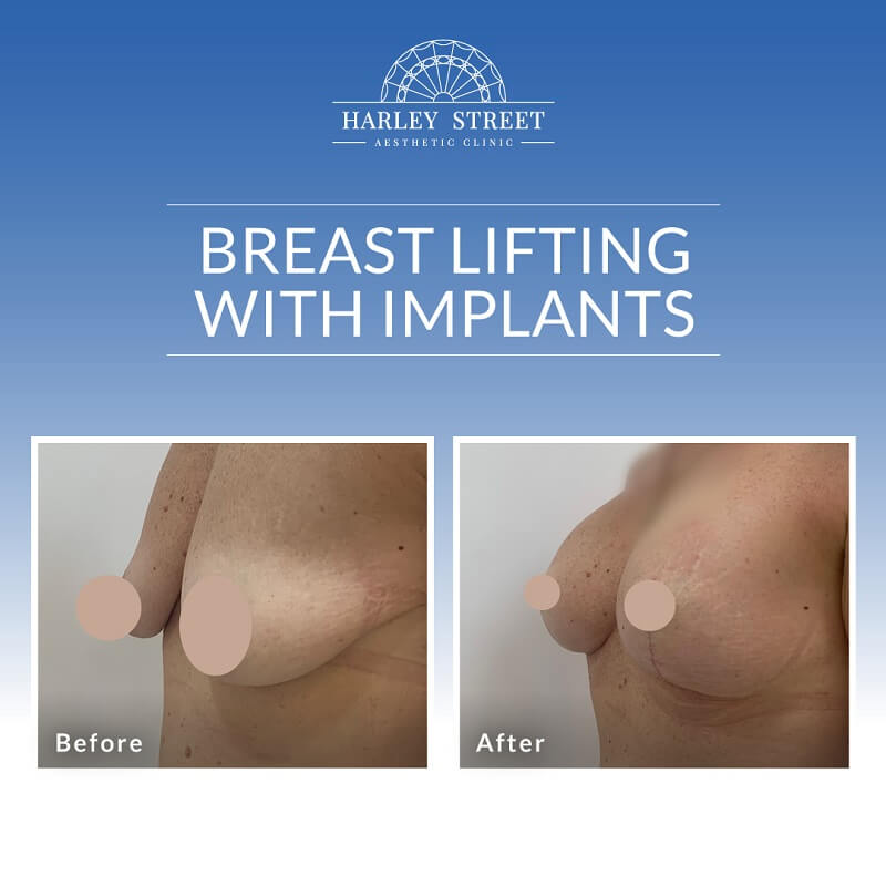 Breast Lifting With Implants