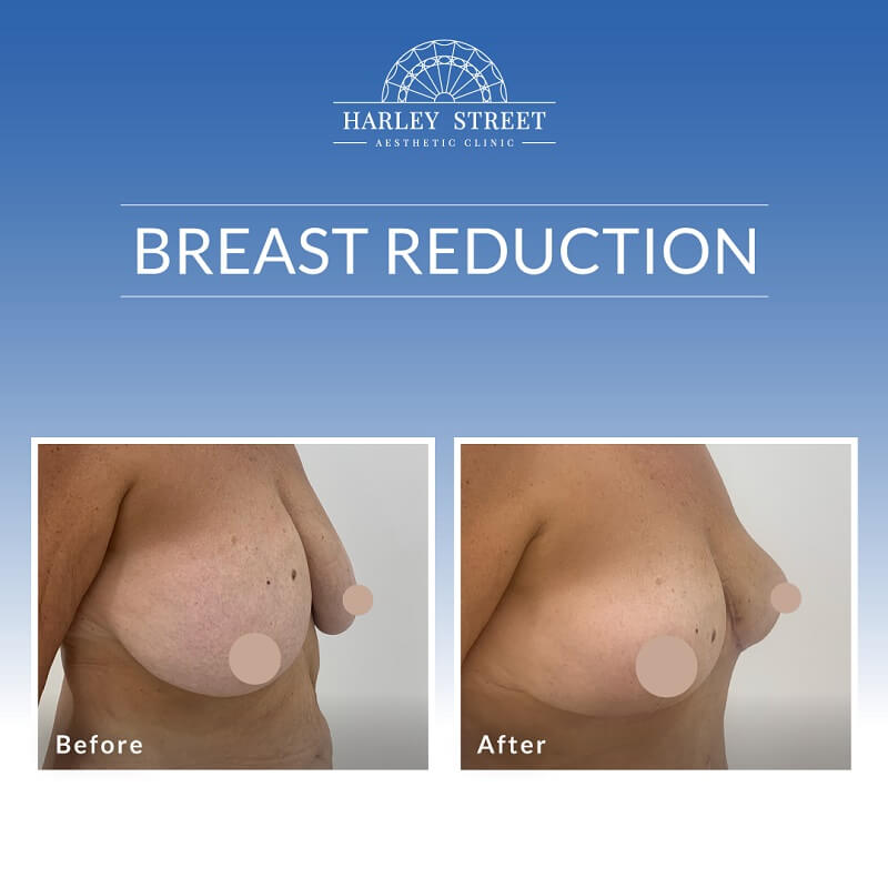 Breast Reduction