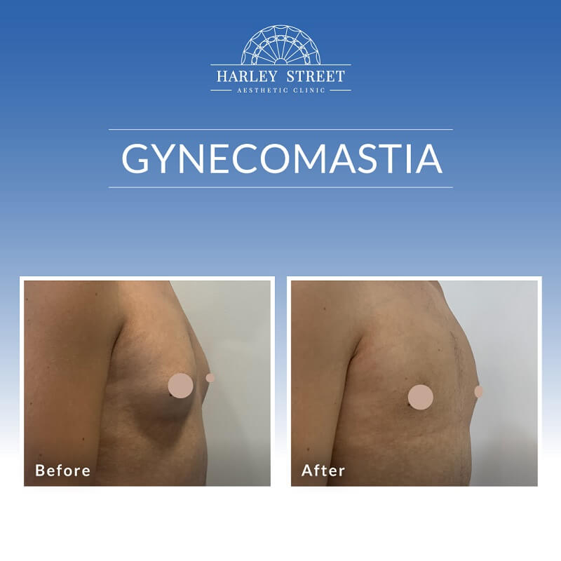 Gynecomastia