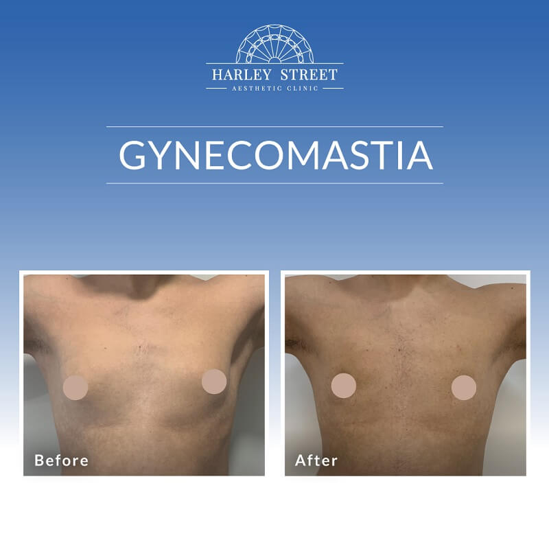 Gynecomastia