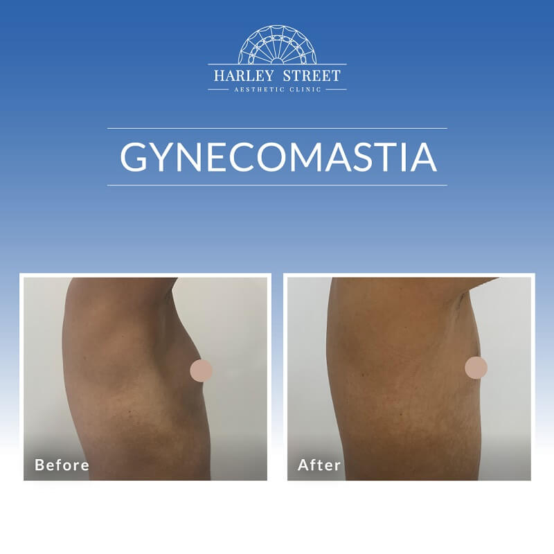Gynecomastia