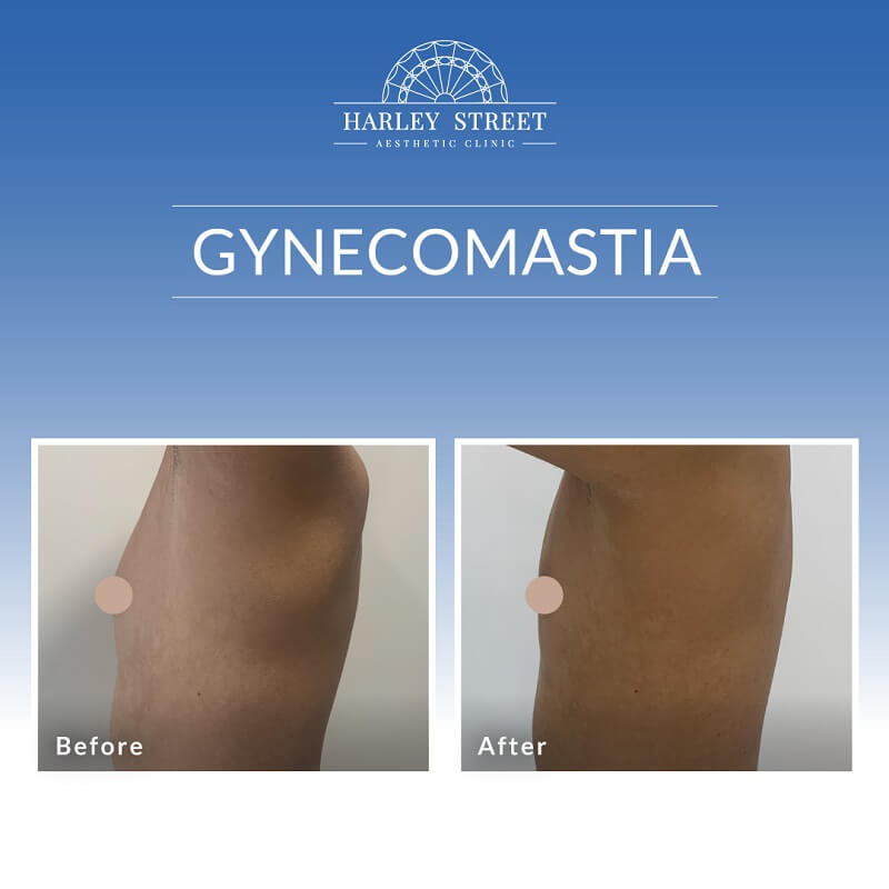 Gynecomastia