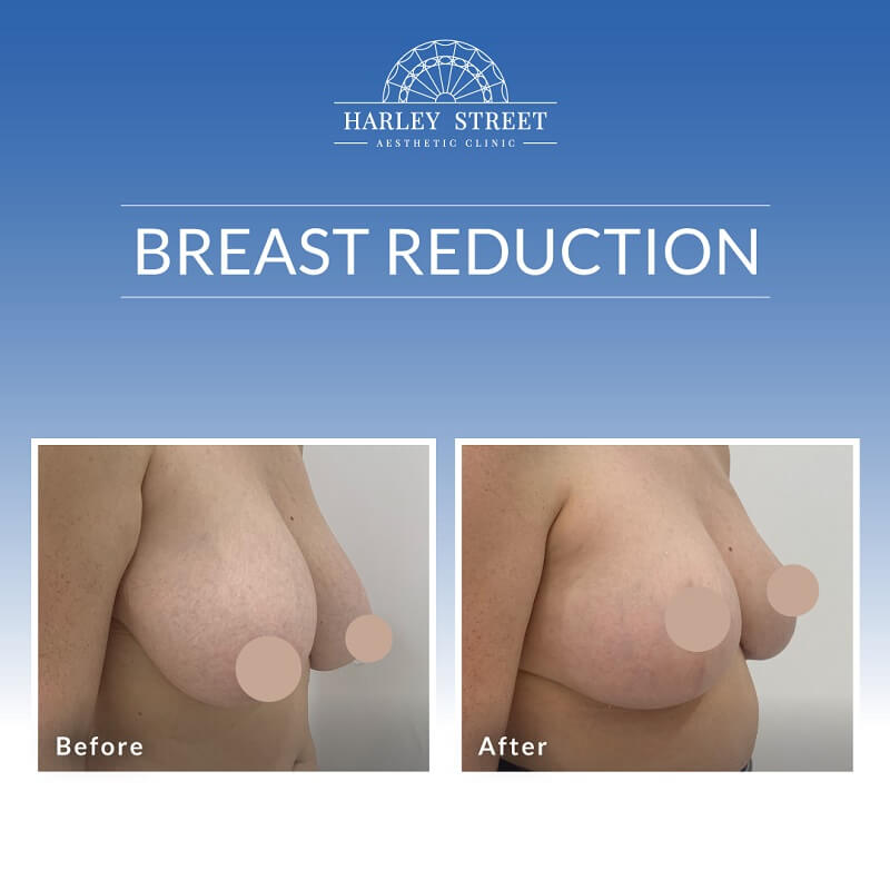 Breast Reduction