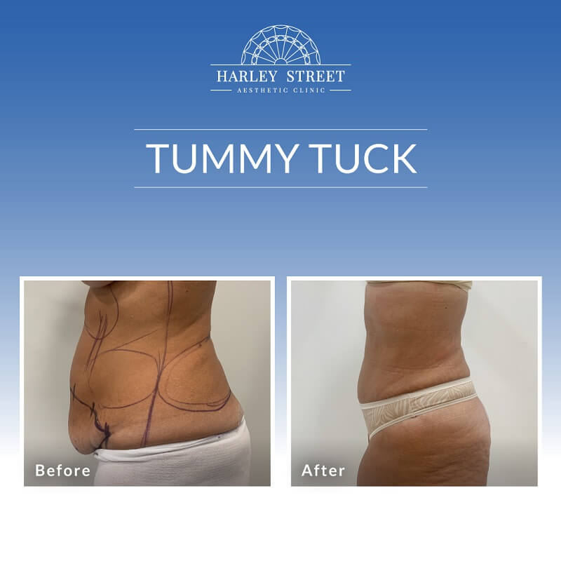 Tummy Tuck